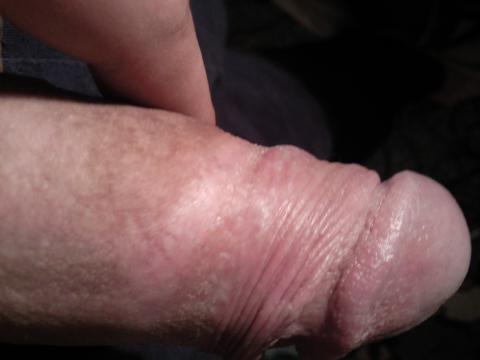 Suchá pokožka na penise