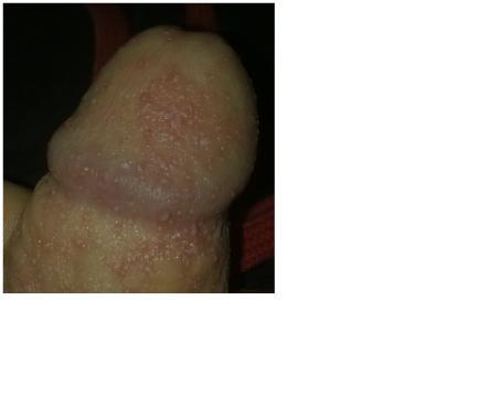 Vyrážka na žaludu